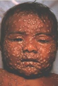 Varíola: lesões cutâneas